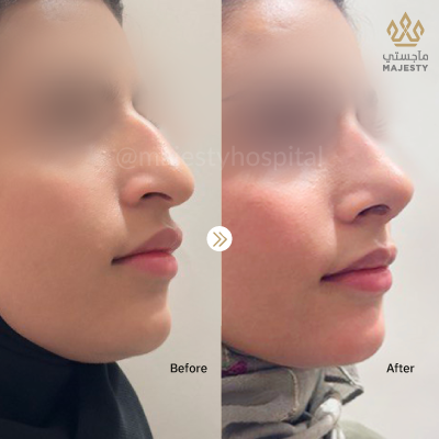 Rhinoplasty -Nose Job  in Riyadh