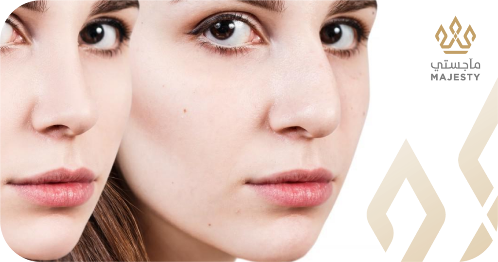 تجميل الانف اللحمي العريض: الحل المثالي لمظهر متناسق