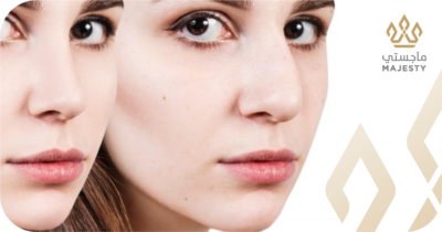 تجميل الانف اللحمي العريض: الحل المثالي لمظهر متناسق