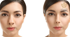 النتائج طويلة الأمد لتجميل الأنف اللحمي العريض