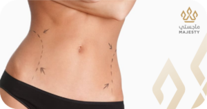 مقارنة بين شفط الدهون الجراحي وغير الجراحي