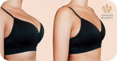 هل تكبير الثدي بالدهون دائم؟ اكتشفي الحقيقة