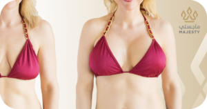 كيف تتم عملية تكبير الصدر2