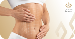 فترة التعافي بعد شفط دهون البطن