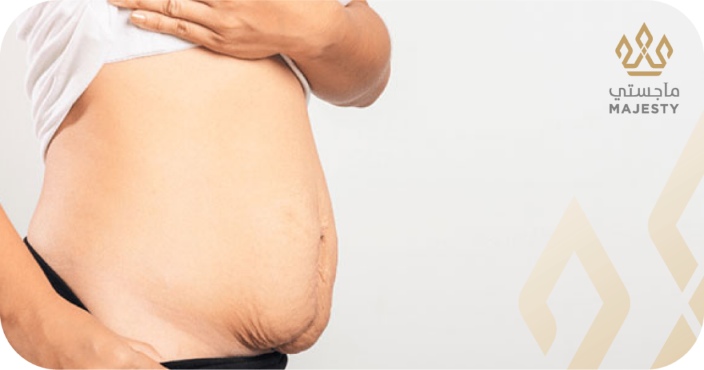 هل يمكن لشد البطن إزالة علامات التمدد بفعالية؟