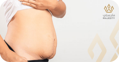 هل يمكن لشد البطن إزالة علامات التمدد بفعالية؟