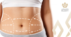 أسباب ظهور علامات التمدد وكيفية التعامل معها