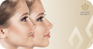 مراحل تجميل الانف2