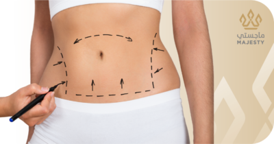 نصائح بعد عملية شد البطن
