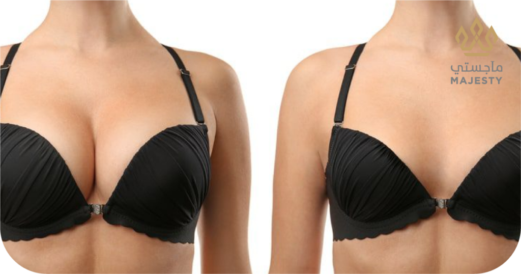 تكبير الثدي بالخلايا الجذعية: طريقة مبتكرة وآمنة