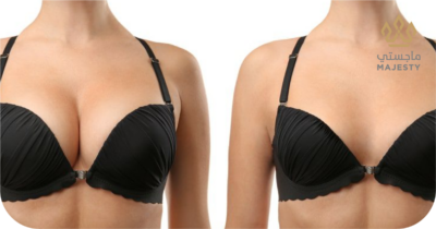 تكبير الثدي بالخلايا الجذعية: طريقة مبتكرة وآمنة