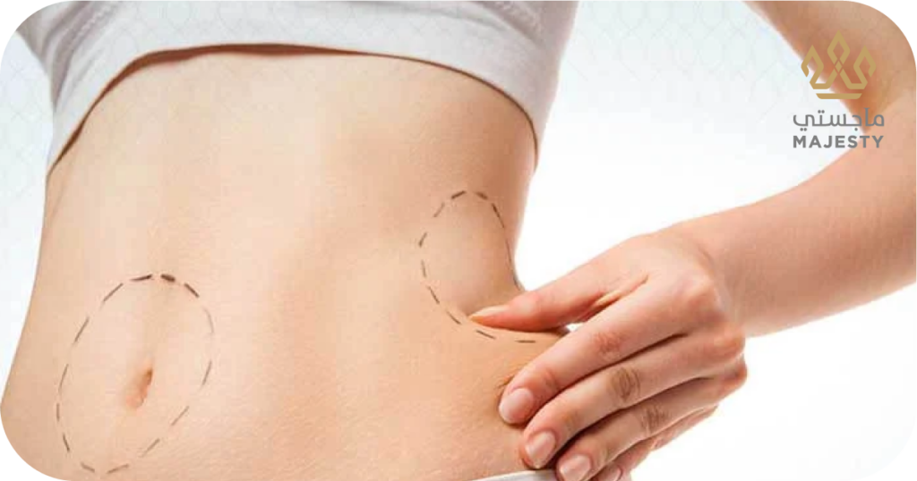 شد البطن بالليزر الموضعي: الحل الأمثل لبطن مشدود