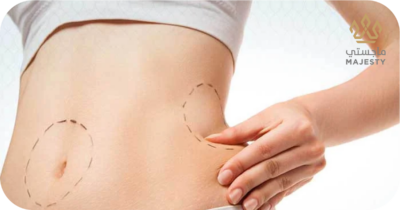 شد البطن بالليزر الموضعي: الحل الأمثل لبطن مشدود