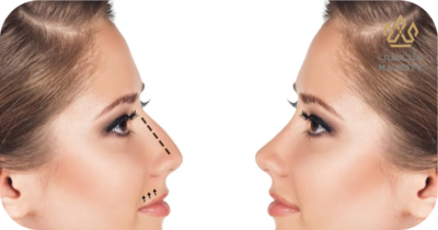 كيف تحافظين على نتائج عملية تجميل الأنف لأطول فترة ممكنة