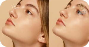 العوامل المؤثرة على نتائج تجميل الأنف