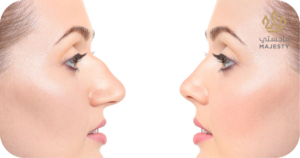 تكلفة تجميل الأنف وتأثيرها على نسبة النجاح