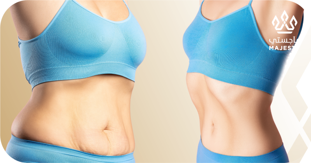 أفضل دكتور شفط دهون البطن في الرياض