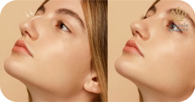 سعر عملية تجميل الانف: التكاليف وأهم العوامل المؤثرة