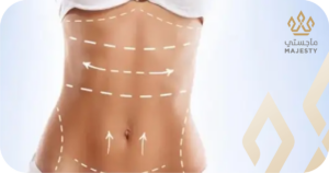 العوامل المؤثرة في الحفاظ على نتائج شفط دهون البطن