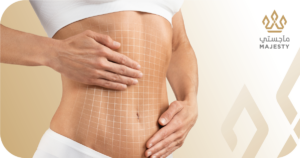 نتائج نحت الجسم بالهايفو