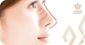 الاستشفاء بعد تجميل الأنف ثري دي