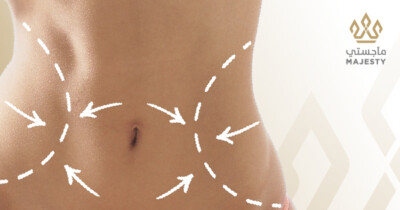 كل ما تحتاجين معرفته عن عملية شد البطن الكامل