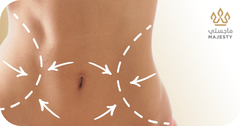 هل يمكن إجراء عملية الفتق مع شد البطن؟ اكتشفوا ذلك الآن