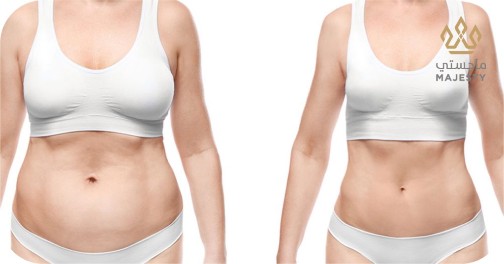 دليلك الشامل لشفط دهون البطن عالي الدقة