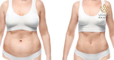 دليلك الشامل لشفط دهون البطن عالي الدقة