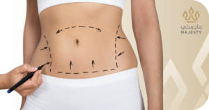 تجربتي مع عملية نحت الجسم