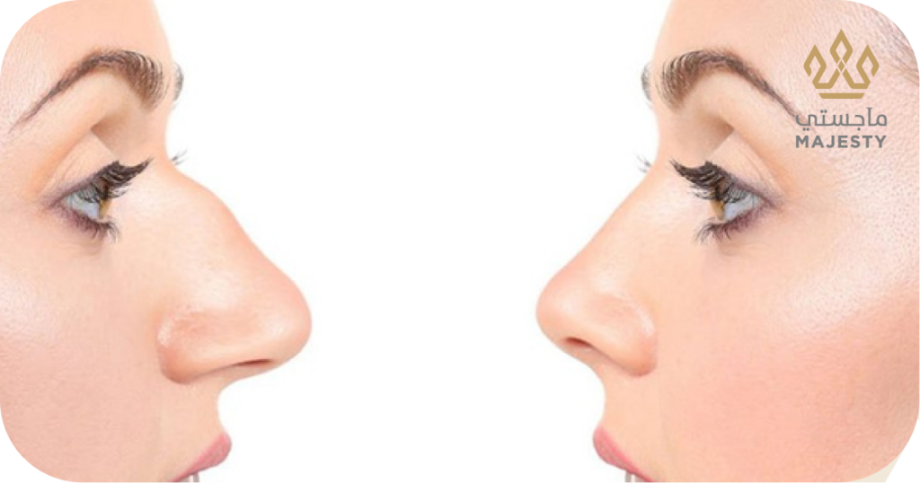 عملية تصغير الأنف: دليلك الشامل لتحقيق الأنف المثالي