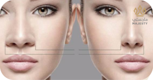 نصائح قبل إجراء عملية تصغير الأنف