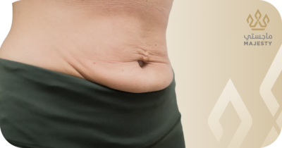 عملية شد البطن بعد الولادة: دليلكِ الكامل لاستعادة الشكل المثالي
