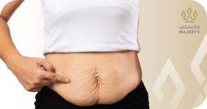 عملية شد البطن بعد الولادة