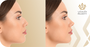 العناية بعد عمليات تجميل الأنف