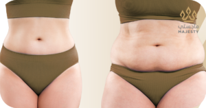 نصائح لتقليل مدة التعافي بعد عملية شفط دهون البطن