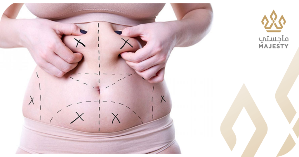 نصائح بعد عملية شفط دهون البطن