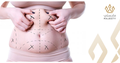 نصائح بعد عملية شفط دهون البطن