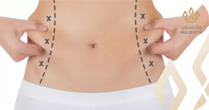 نصائح بعد عملية شفط دهون البطن