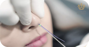 نتائج تجميل الأنف بالخيوط