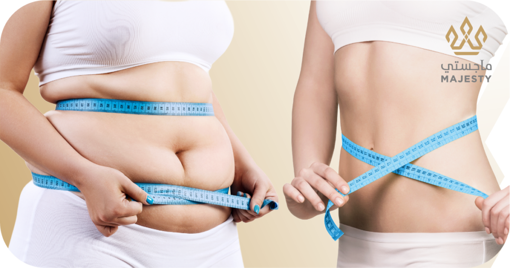 الفرق بين شد البطن وشفط الدهون: أيهما يناسبك؟