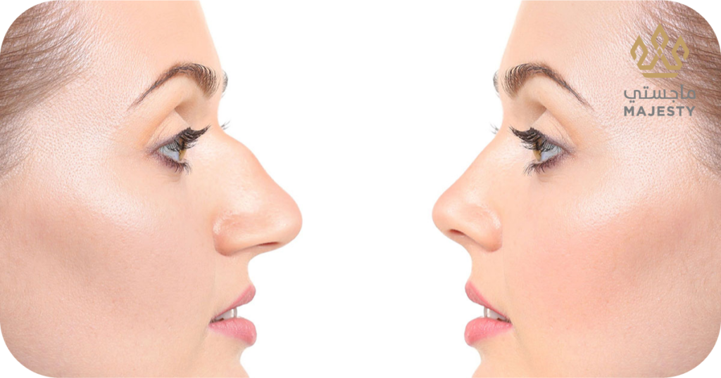 الفرق بين جراحة الأنف وفيلر الأنف: الاختيار الأفضل
