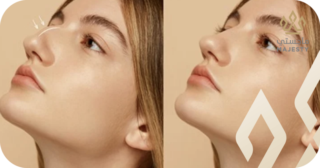 تجربتي مع عملية تجميل الأنف: من يوم العملية إلى النتائج النهائية