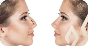 تجربتي مع عملية تجميل الأنف