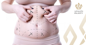 تجارب شفط دهون البطن