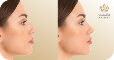 عملية ترميم الأنف: دليلك الشامل لتحقيق الأنف المثالي