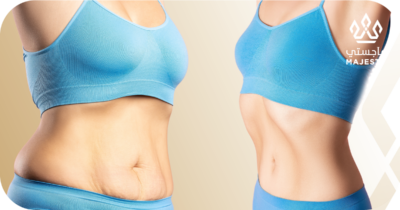 تكلفة شفط دهون البطن: الأسعار وأهم العوامل
