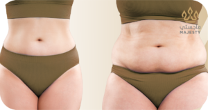 نصائح لاختيار جراح شد البطن المناسب