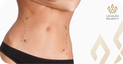 نسبة نجاح عملية شد البطن وعواملها الأساسية