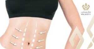 نتائج عملية شد البطن المتوقعة